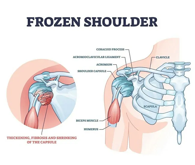 Causes & Risk Factors of Frozen Shoulder