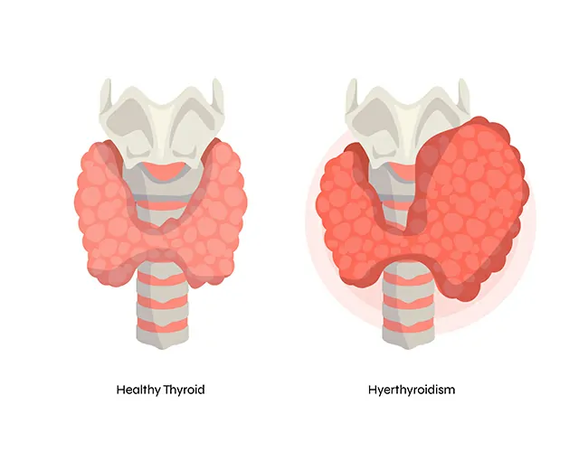Symptoms of Thyroid Disorders