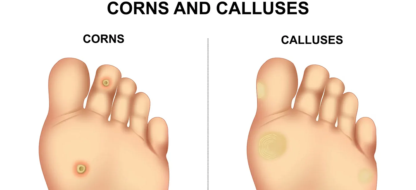 Warts & Corn Foot – Causes, Types & Natural Healing with Ayurveda, Siddha & Homeopathy