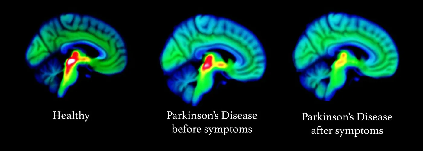 Parkinson’s Disease: Holistic Healing Through Ayurveda, Siddha & Homeopathy