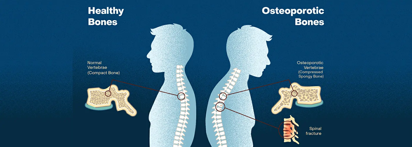 Osteoporosis & Calcium Deficiency: Causes, Symptoms & Holistic Treatments