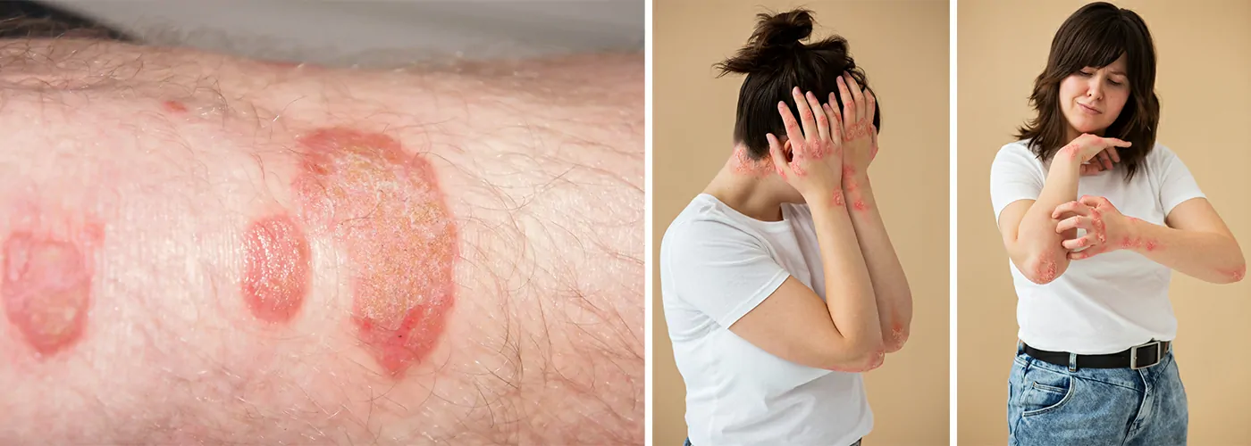 Psoriasis – Causes, Symptoms & Natural Healing with Ayurveda, Siddha & Homeopathy