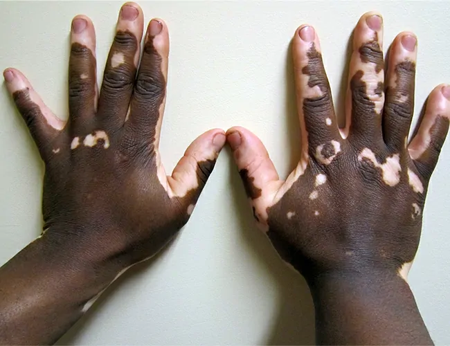 What is Vitiligo?