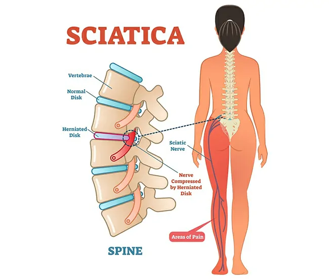 Causes of Sciatica