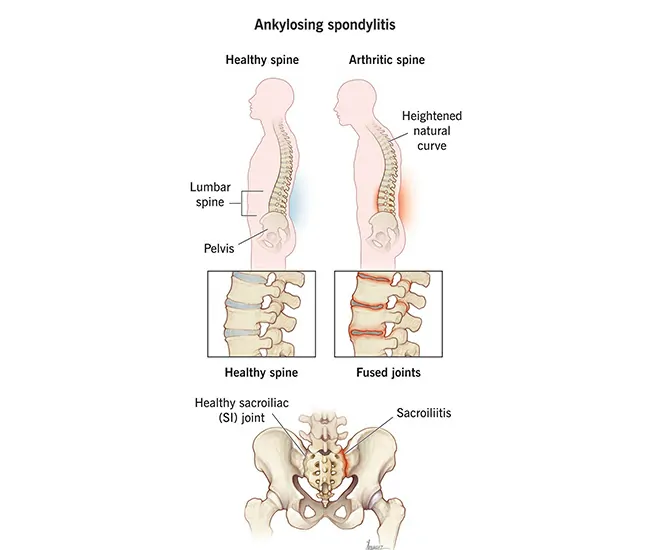 What is Ankylosing Spondylosis?