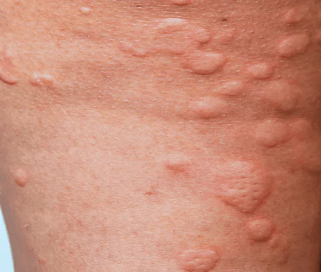 Symptoms of Urticaria