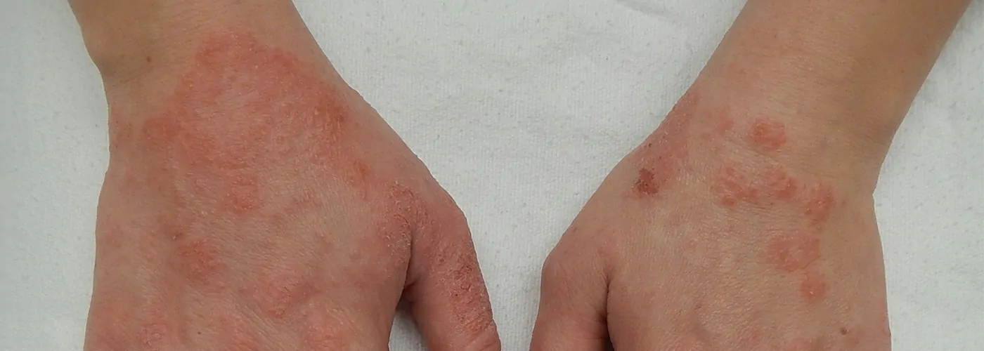 Eczema – Causes, Symptoms & Natural Healing with Ayurveda, Siddha & Homeopathy