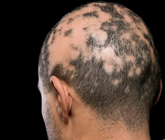 What is Alopecia Areata?