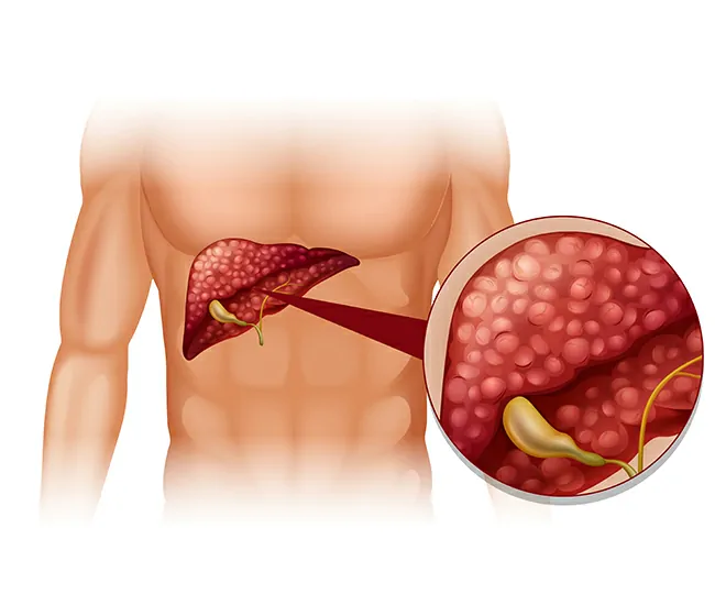 What is Cholelithiasis (Gallstones)?