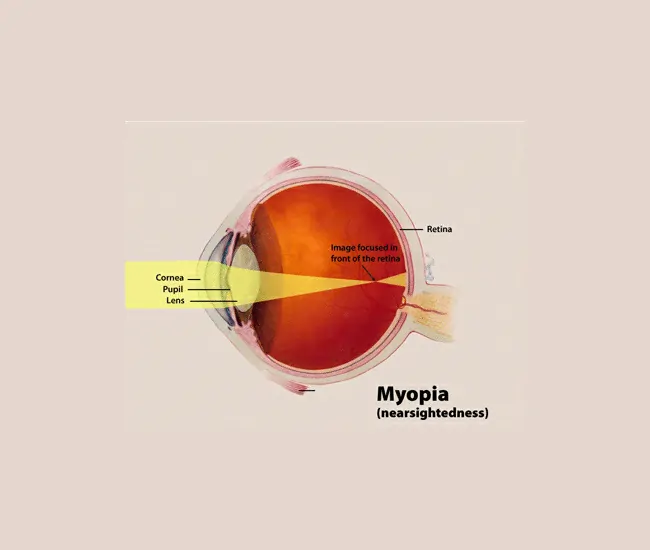  Ayurvedic Approach to Presbyopia and Myopia