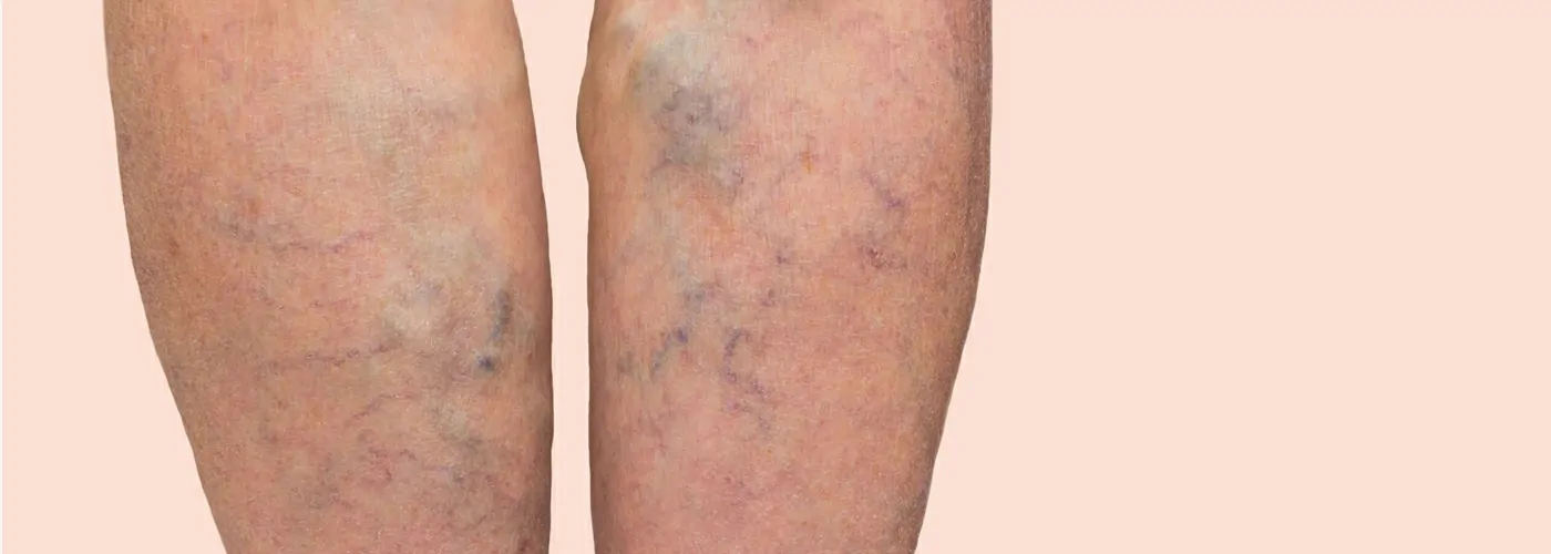 Varicose Veins – Causes, Symptoms & Holistic Treatments