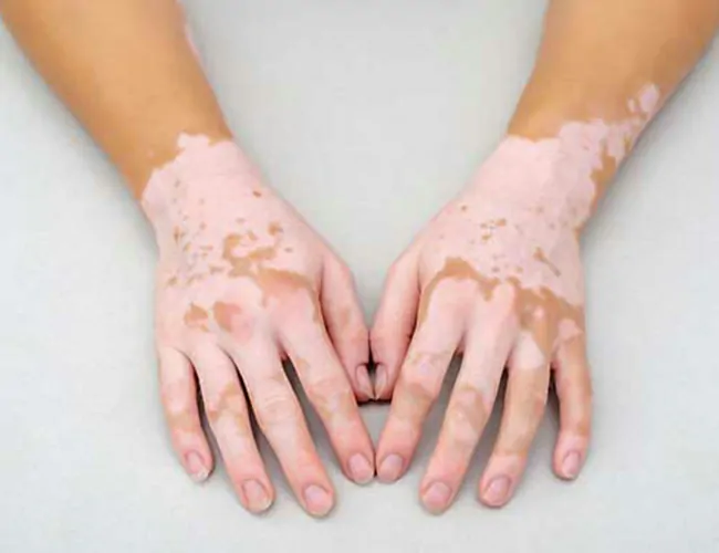  Homeopathic Treatment