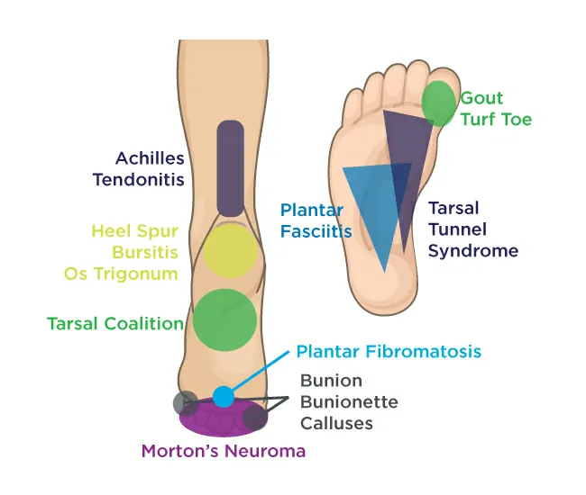 Causes of Foot Pain & Heel Spurs