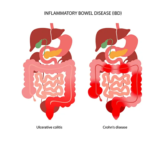 Symptoms of IBS & IBD