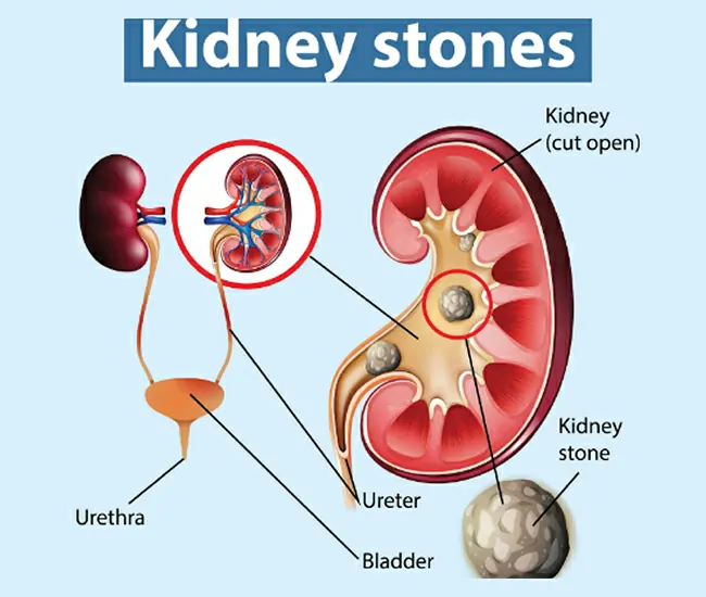 What are Kidney Stones?
