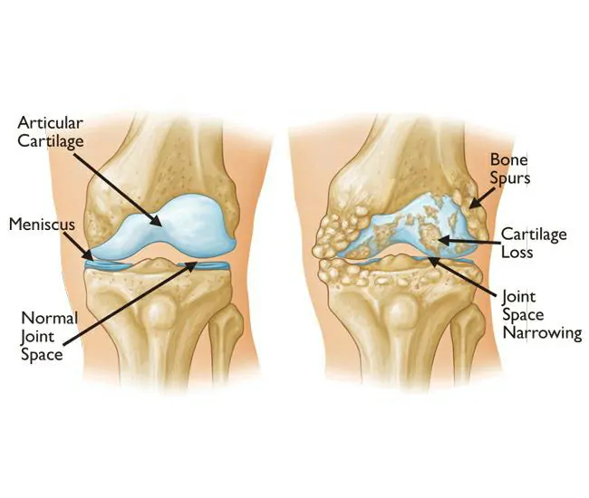 Causes of Knee Osteoarthritis