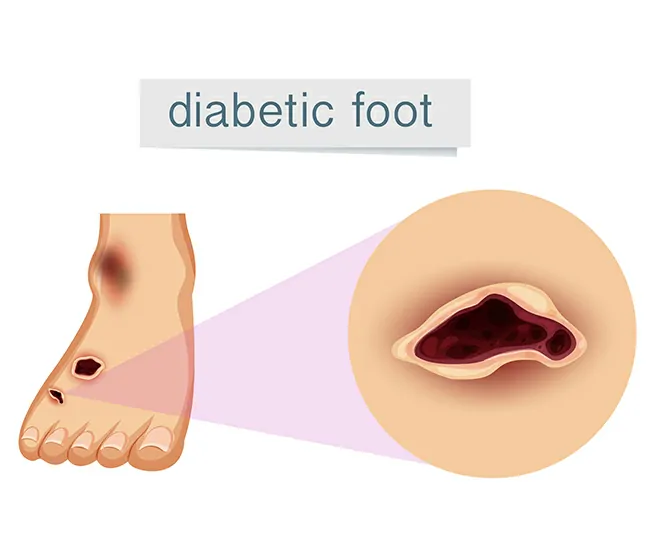 Causes of Diabetic Neuropathy