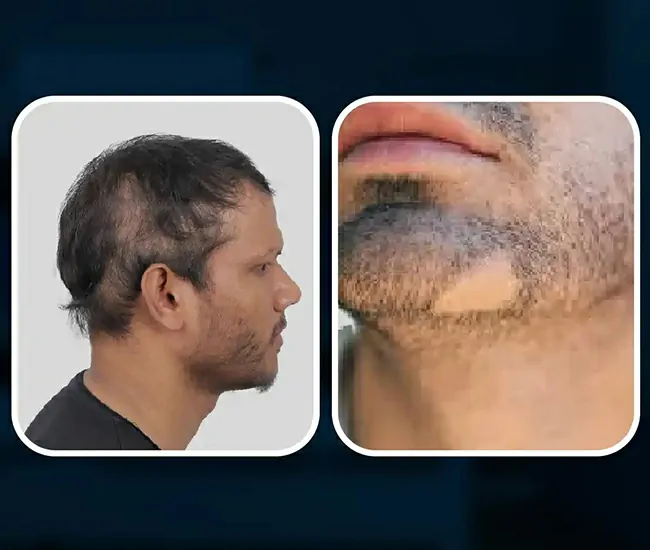 Symptoms of Alopecia Areata in Males