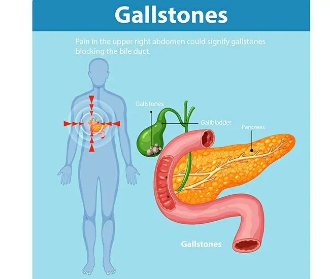 Symptoms of Gallstones