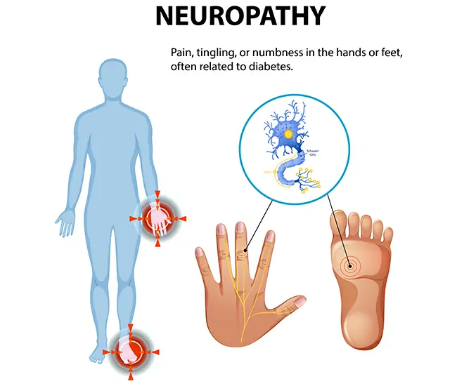 What is Diabetic Neuropathy?