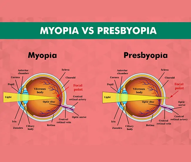 What is Presbyopia and Myopia ?