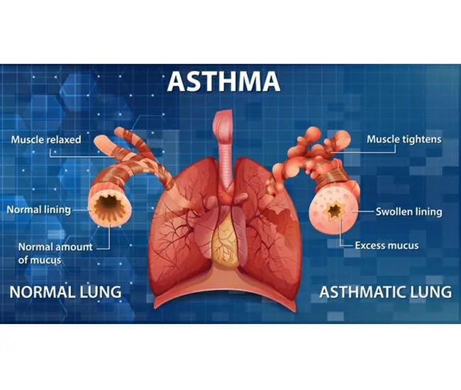 Causes of Asthma & Bronchitis
