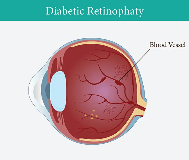 What is Diabetic Retinopathy?