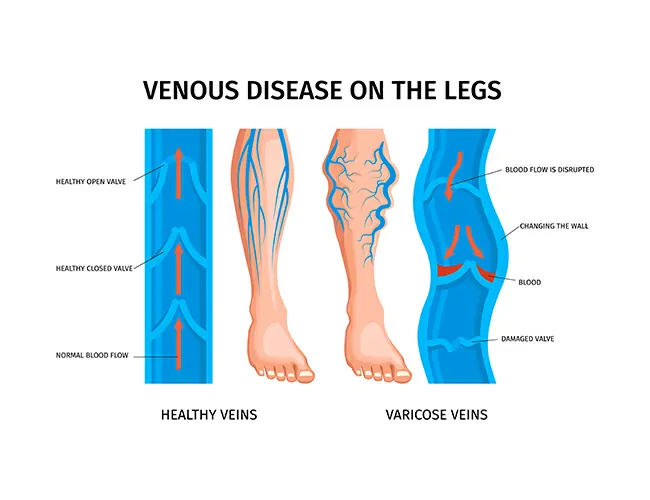 Causes & Risk Factors