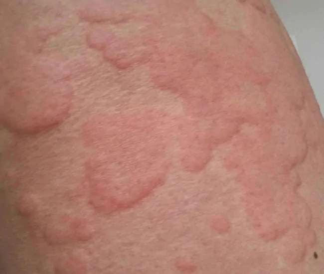 Causes of Urticaria (Hives)