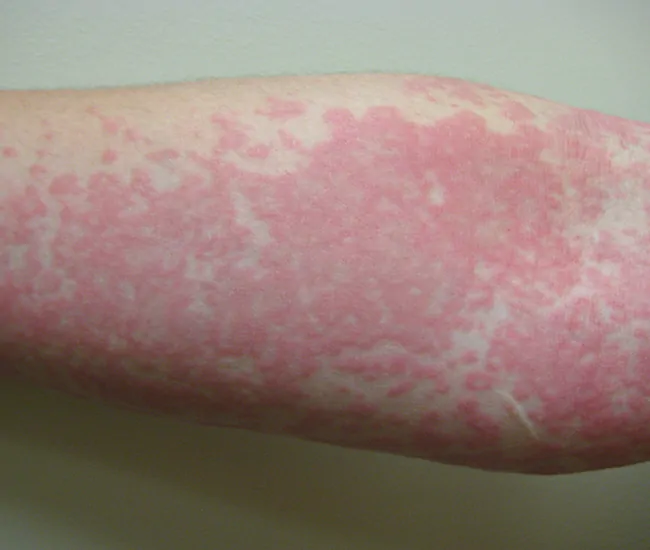 What is Urticaria (Hives)?