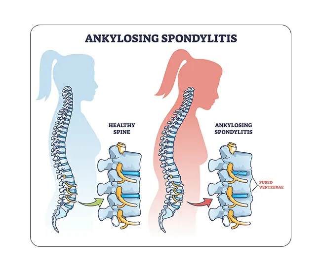 Symptoms of Ankylosing Spondylosis