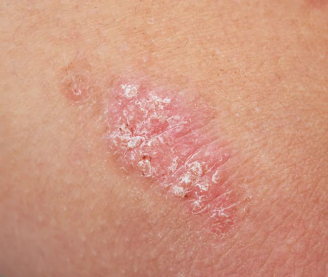 Symptoms of Psoriasis