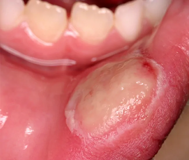What are Mouth Ulcers?