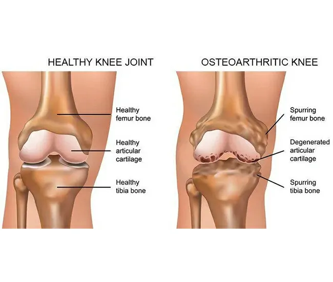 Symptoms of Knee Osteoarthritis