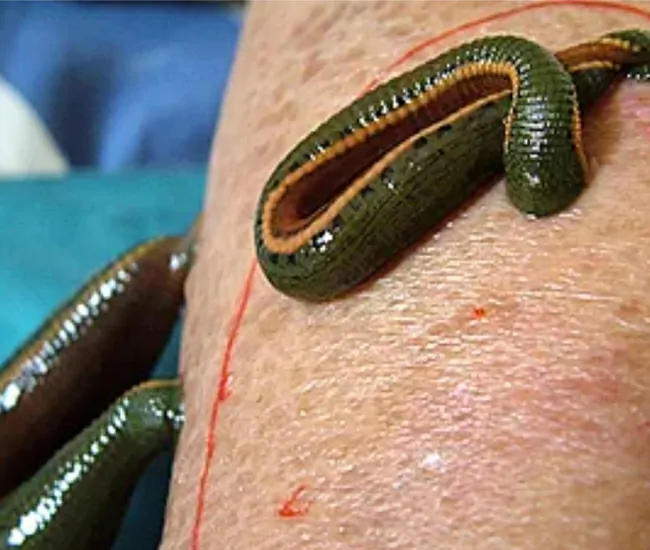 Benefits of Raktamokshana