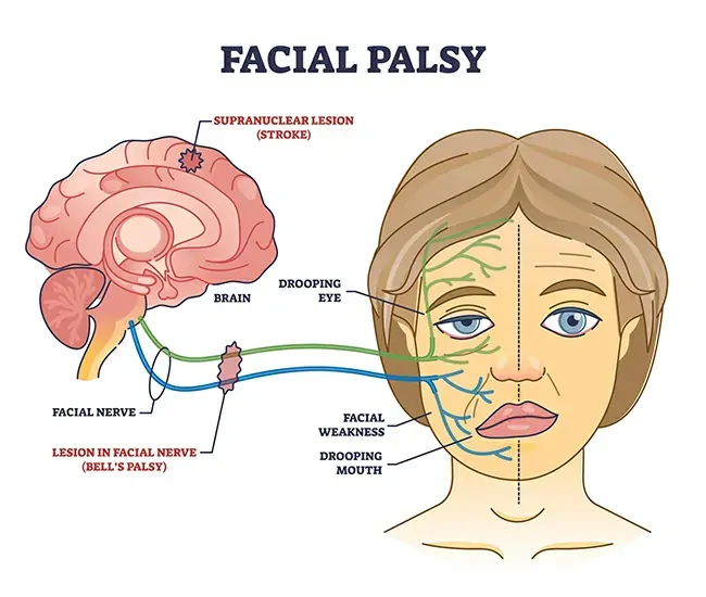 Symptoms of Bell’s Palsy
