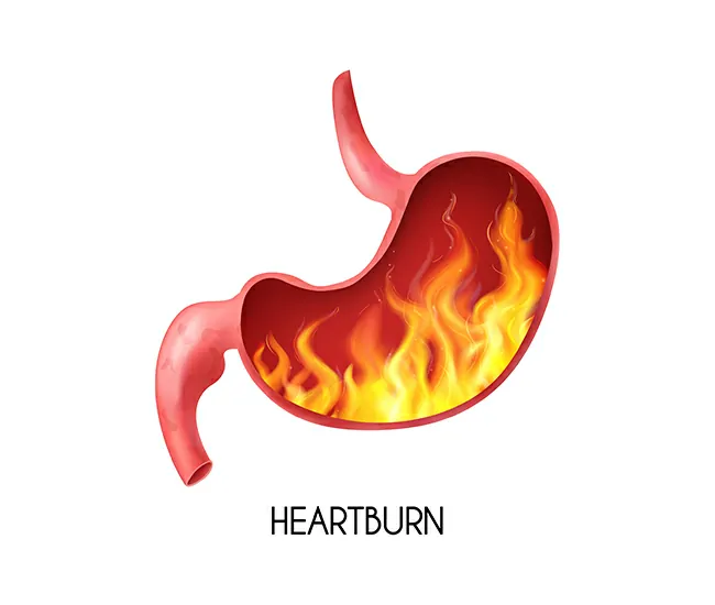 What is GERD, Acidity, and Acid Reflux?