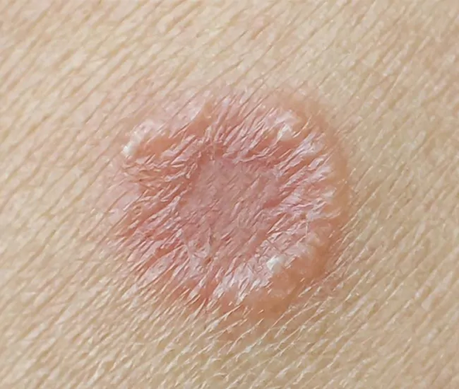 Causes of Fungal Infections & Jock Itch