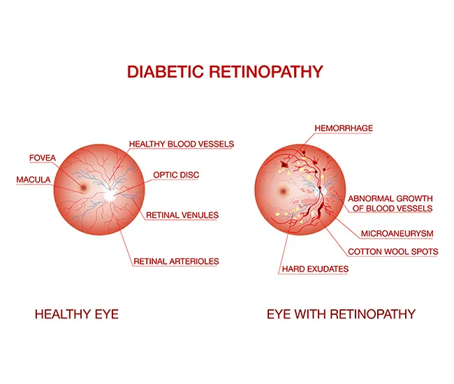 Causes & Risk Factors