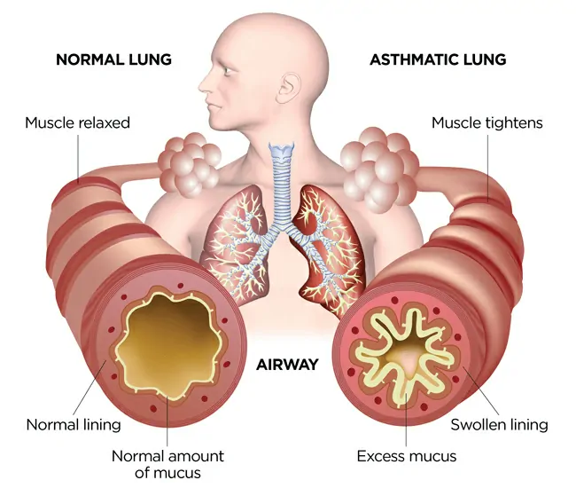 Types of Cough & Respiratory Conditions