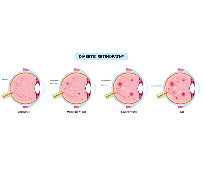 Stages of Diabetic Retinopathy
