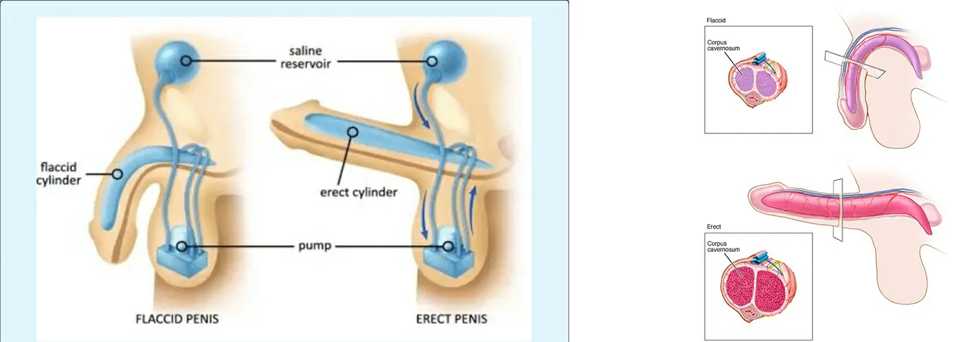 Erectile Dysfunction (ED) – Causes, Types, Symptoms & Treatment