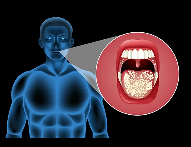Causes of Tonsillitis & Adenoid Enlargement