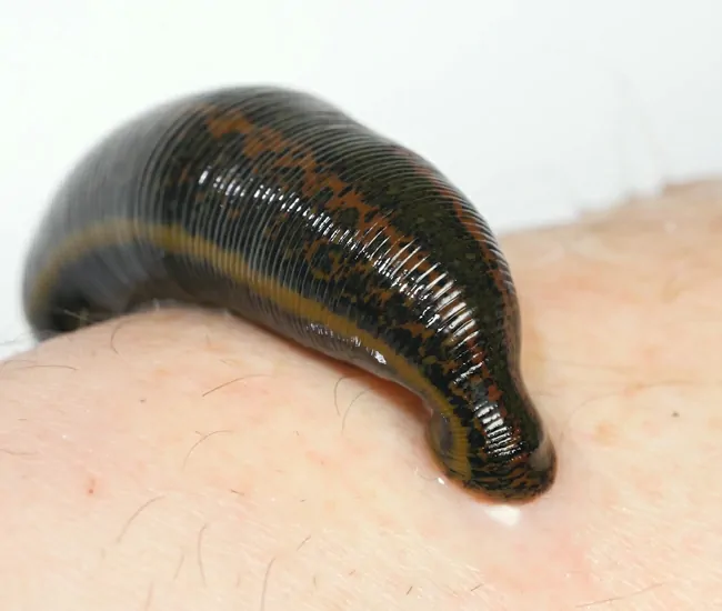 Raktamokshana in Various Diseases