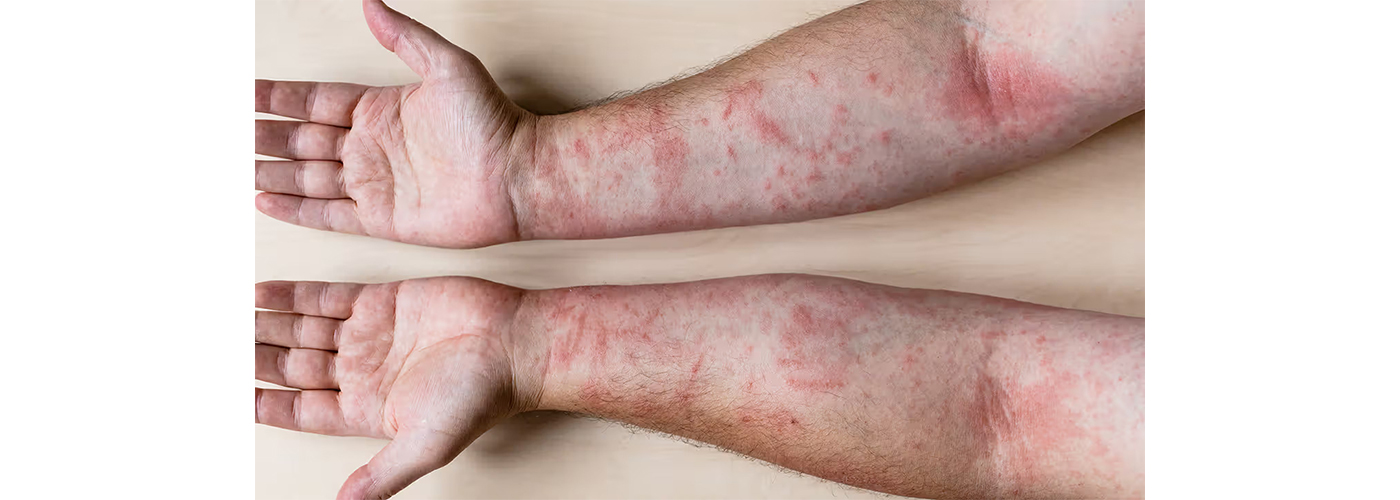 Allergic Dermatitis: Causes, Symptoms & Holistic Treatments