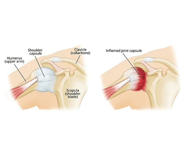 What is Frozen Shoulder (Adhesive Capsulitis)?