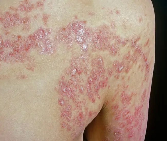 What is Psoriasis?