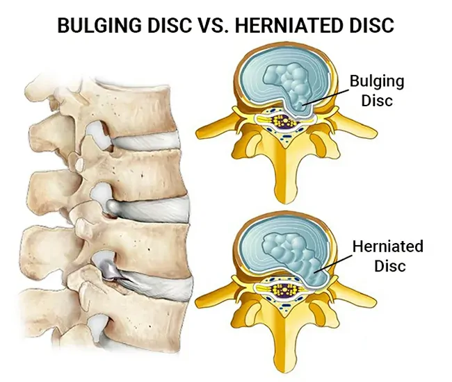 Causes of Disc Bulge & Spine Degeneration