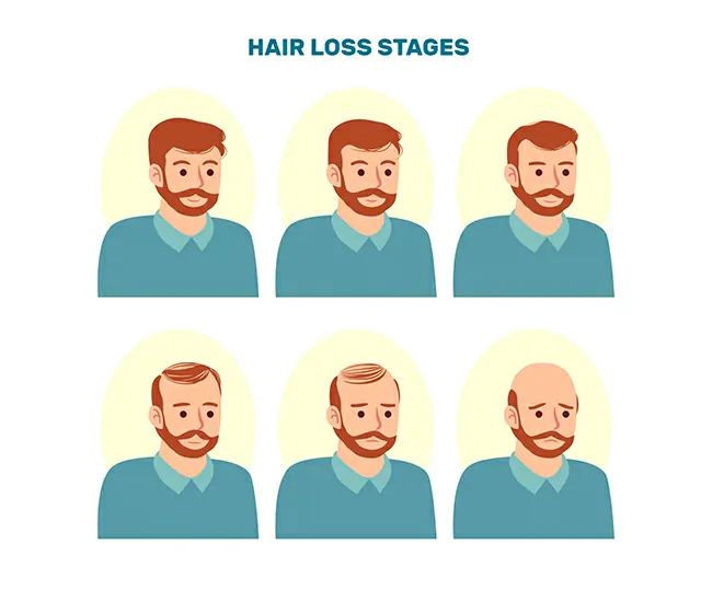 Types & Stages of Male Pattern Baldness