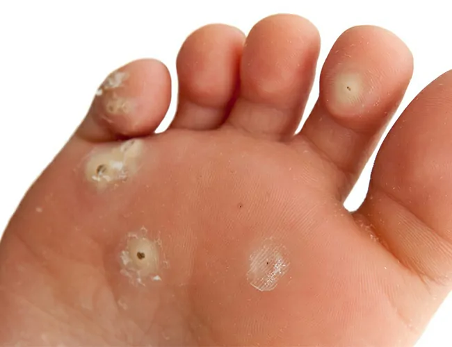 Types of Warts